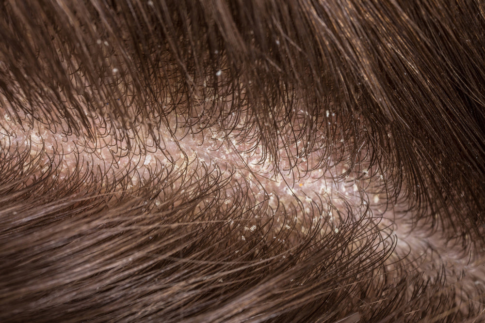 Different Scalp Conditions and their Treatments: What’s there to Know?